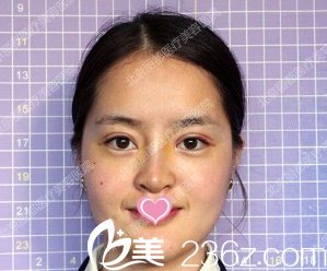 韓式雙眼皮韓式隆鼻術(shù)后第十天的樣子 韓式雙眼皮韓式隆鼻術(shù)后第十天的樣子