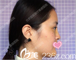 在麗都做雙眼皮隆鼻術(shù)后二十八天的樣子 在麗都做雙眼皮隆鼻術(shù)后二十八天的樣子