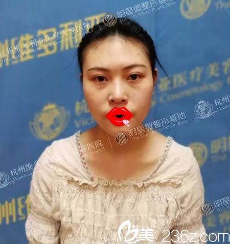 做自體脂肪填充前的大餅臉 做自體脂肪填充前的大餅臉