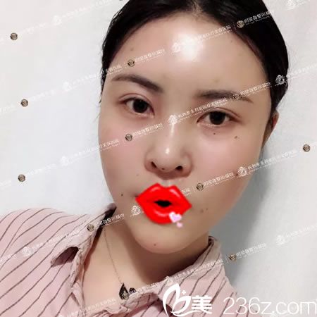 找維多利亞馬騰做脂肪填充后即刻照片 找維多利亞馬騰做脂肪填充后即刻照片