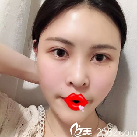 杭州維多利亞自體脂肪填充案例5天效果 杭州維多利亞自體脂肪填充案例5天效果