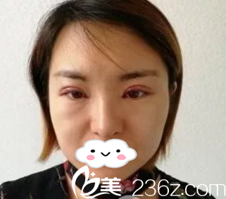 手術(shù)當(dāng)天 手術(shù)當(dāng)天