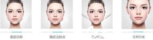 注射瘦臉瘦臉過(guò)程 注射瘦臉瘦臉過(guò)程