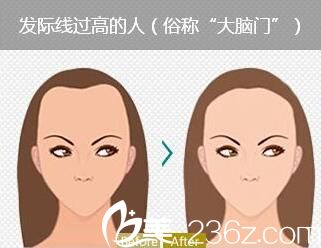 發(fā)際線過高調(diào)整 發(fā)際線過高調(diào)整