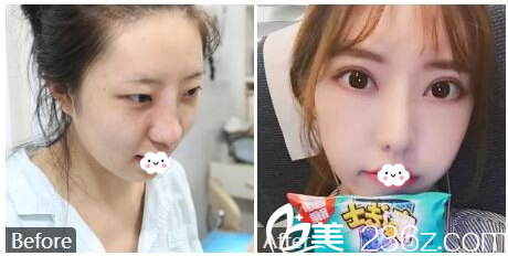 廣州曙光劉永波隆鼻失敗修復(fù)<span style=