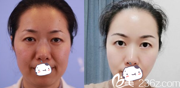合肥白領(lǐng)安琪兒美迪塑PPDO面部提升案例效果對(duì)比圖