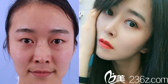 鼻綜合+眼綜合效果圖