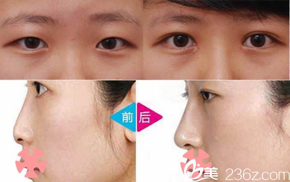 泉州東大雙眼皮和鼻綜合隆鼻<span style=