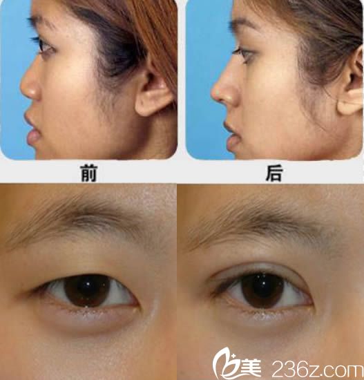 泉州東大裴彥鵬雙眼皮和綜合隆鼻案例 泉州東大裴彥鵬雙眼皮和綜合隆鼻案例