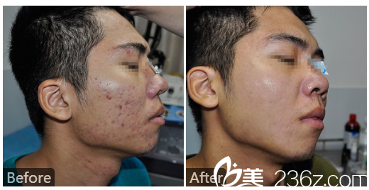  廣東藥科<!--<i data=20240709-sp></i>-->廣州復(fù)星禪誠醫(yī)院皮膚科皮膚疤痕科巫尾英醫(yī)生激光祛除痘坑實(shí)例