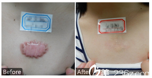  廣東藥科<!--<i data=20240709-sp></i>-->廣州復(fù)星禪誠醫(yī)院皮膚科皮膚科巫尾英好不好？看疤痕增生修復(fù)實(shí)例對(duì)比圖