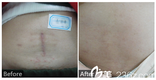  廣東藥科<!--<i data=20240709-sp></i>-->廣州復(fù)星禪誠醫(yī)院皮膚科皮膚科巫尾英怎么樣？看看剖腹產(chǎn)疤痕祛除實(shí)例