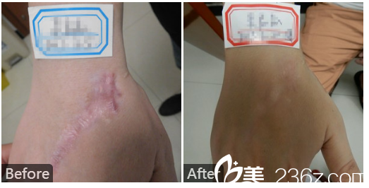  廣東藥科<!--<i data=20240709-sp></i>-->廣州復(fù)星禪誠醫(yī)院皮膚科皮膚疤痕科巫尾英手背疤痕修復(fù)實(shí)例