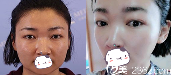 合肥白領(lǐng)安琪兒瘦臉除皺前后對比效果圖 合肥白領(lǐng)安琪兒瘦臉除皺前后對比效果圖