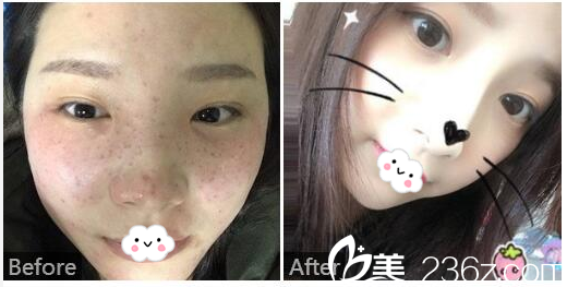  廣東藥科<!--<i data=20240709-sp></i>-->廣州復(fù)星禪誠醫(yī)院皮膚科皮膚疤痕科巫尾英醫(yī)生巫尾英皮秒激光祛斑實(shí)例