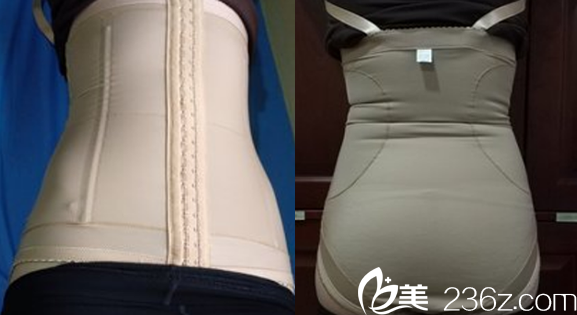 白領(lǐng)安琪兒梁啟春腰腹抽脂術(shù)后8天照片