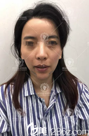 線雕提升術前拍照 線雕提升術前拍照