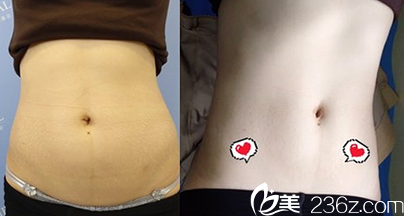 腰腹吸脂對比圖片
