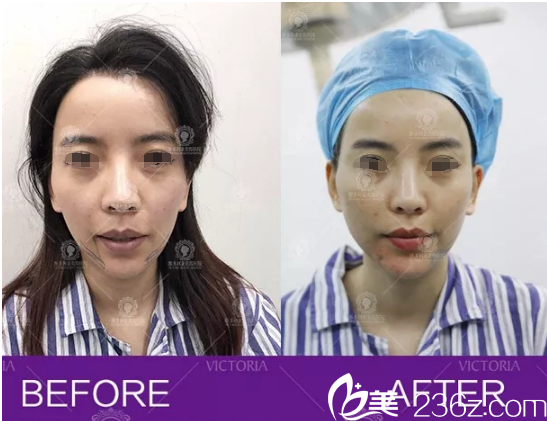 皮膚松垮、顯老的上班族媽媽找南京維多利亞金頌良院長做線雕提升即刻對比照