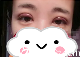 術(shù)后第四天 術(shù)后第四天