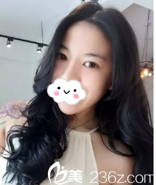 哈爾濱藝星張寧醫(yī)生雙眼皮手術(shù)好不好？雙眼皮+開眼角真人案例