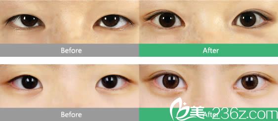 泉州東大徐海燕雙眼皮和上瞼下垂矯正案例