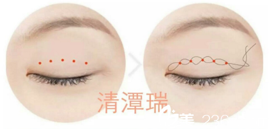 李奎?發(fā)明“SNS自然粘連法”術式 李奎?發(fā)明“SNS自然粘連法”術式