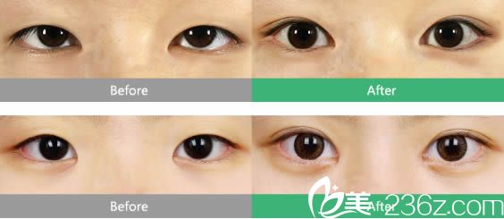 泉州東大雙眼皮和上瞼下垂矯正案例圖