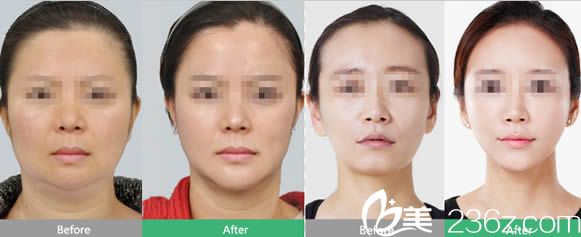 全臉線雕提升和自體脂肪填充全面部前后對(duì)比照