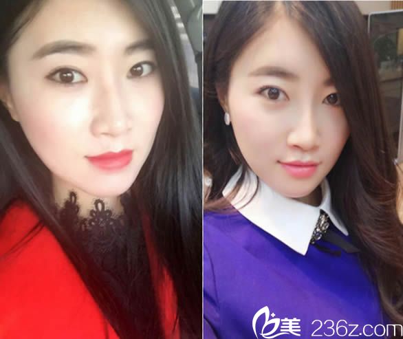 我感覺泉州東大整形醫(yī)院挺正規(guī)的，就去找裴彥鵬做了自體肋軟骨鼻綜合隆鼻