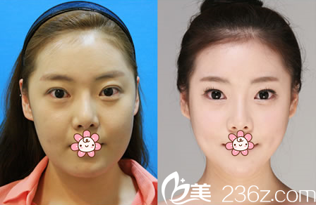 鄭潤載院長眼角修復(fù)案例