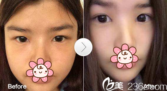 鄭潤載院長開內(nèi)眼角案例