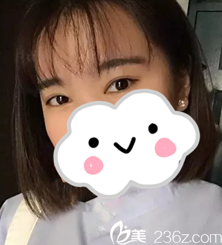 邵陽曹家美容整形醫(yī)院雙眼皮怎么樣？真人案例
