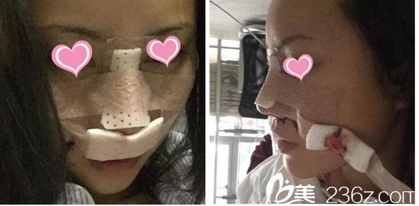 吳禮誠隆鼻手術(shù)真人案例