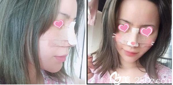 贛州亞韓整形隆鼻手術(shù)真人案例