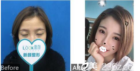 珠海新顏美容醫(yī)院<!--<i data=20240703-sp></i>-->做的切開雙眼皮案例 珠海新顏美容醫(yī)院<!--<i data=20240703-sp></i>-->做的切開雙眼皮案例