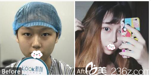 珠海新顏<!--<i data=20240703-sp></i>-->主任鼻綜合隆鼻案例 珠海新顏<!--<i data=20240703-sp></i>-->主任鼻綜合隆鼻案例