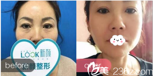 珠海新顏整形醫(yī)院<!--<i data=20240703-sp></i>-->祛眼袋案例 珠海新顏整形醫(yī)院<!--<i data=20240703-sp></i>-->祛眼袋案例