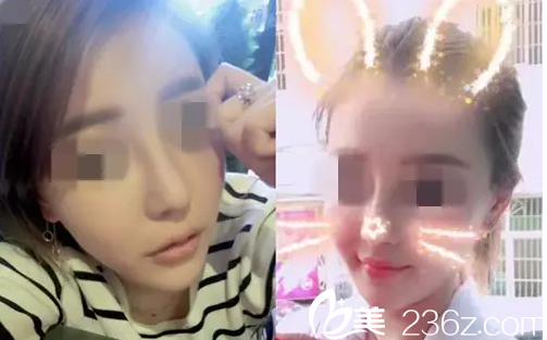 邵陽德美醫(yī)生改變了我塌鼻梁，大鼻頭，讓我重新提高了氣質(zhì)