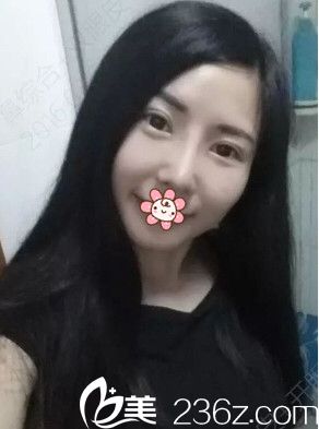 16年飛韓國(guó)夏娃eve整形鄭潤(rùn)載那兒做的假體隆鼻+耳軟骨墊鼻尖+雙眼皮+開(kāi)眼角