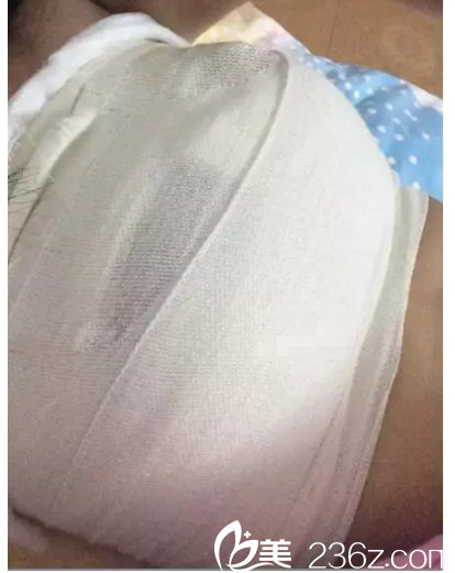 剛做完假體隆胸手術(shù)