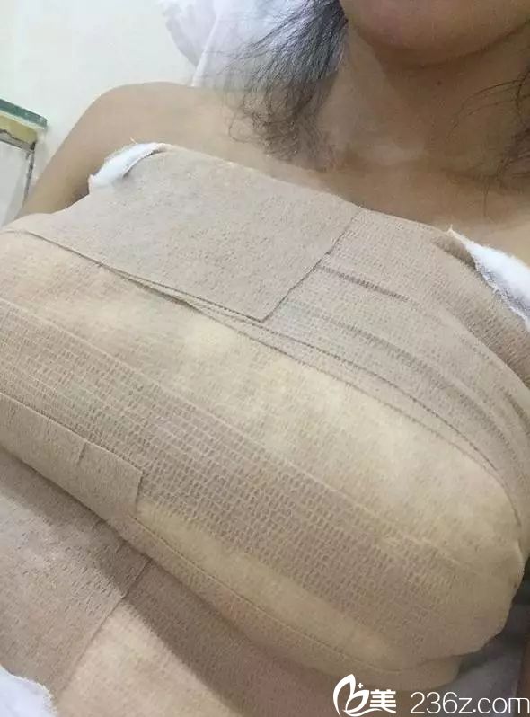 術(shù)后五天假體恢復(fù)中