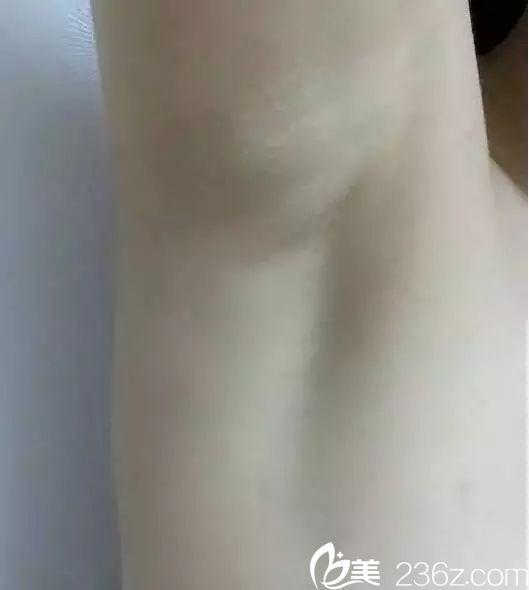 從填不滿的A-cup到傲嬌的C-cup，只因在蘇州芘麗芙華美做了進(jìn)口娜綺麗假體隆胸