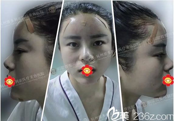 在維多利亞做完鼻子和脂肪填充即刻效果 在維多利亞做完鼻子和脂肪填充即刻效果