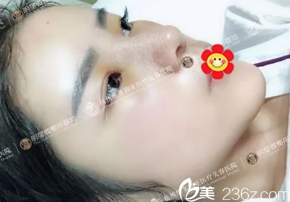 做完脂肪填充和隆鼻術(shù)后1天效果 做完脂肪填充和隆鼻術(shù)后1天效果