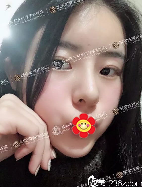 臉部自體脂肪填充和鼻綜合15天效果 臉部自體脂肪填充和鼻綜合15天效果