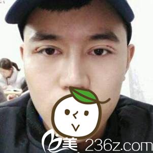 贛州亞韓雙眼皮手術(shù)案例