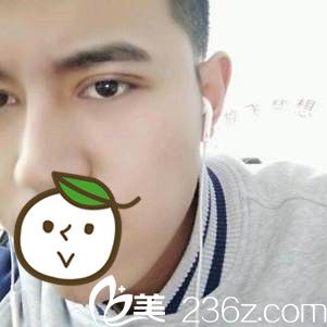 吳禮誠雙眼皮手術(shù)案例