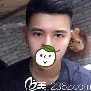 術(shù)后恢復16天效果