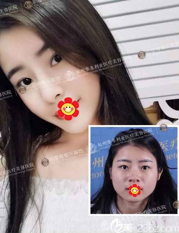 杭州維多利亞劉中策鼻綜合案例對(duì)比圖 杭州維多利亞劉中策鼻綜合案例對(duì)比圖